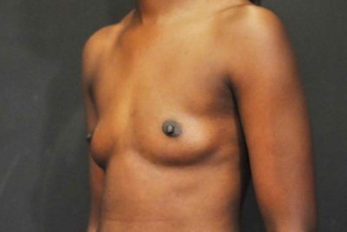 Case #1683 – Breast Augmentation