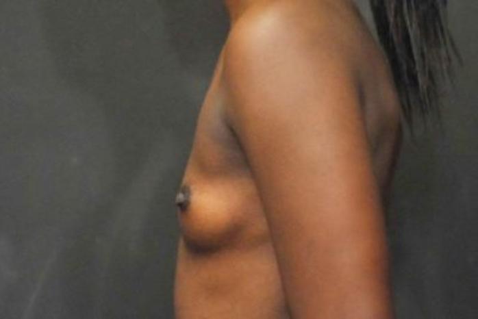 Case #1683 – Breast Augmentation