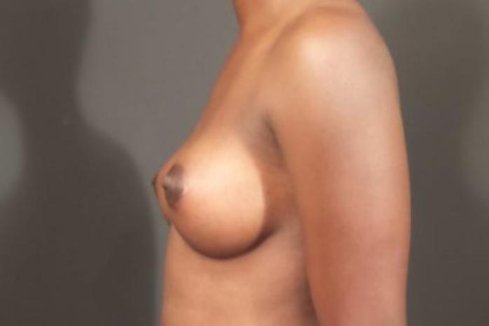 Case #1683 – Breast Augmentation