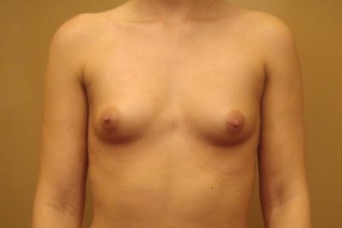 Case #1695 – Breast Augmentation