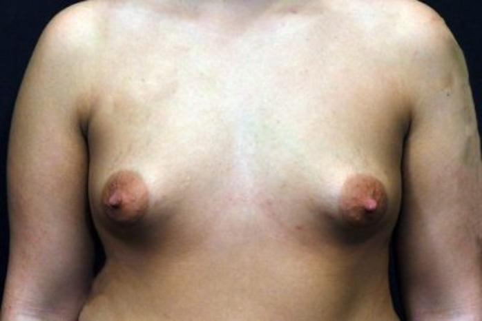 Case #1707 – Breast Augmentation