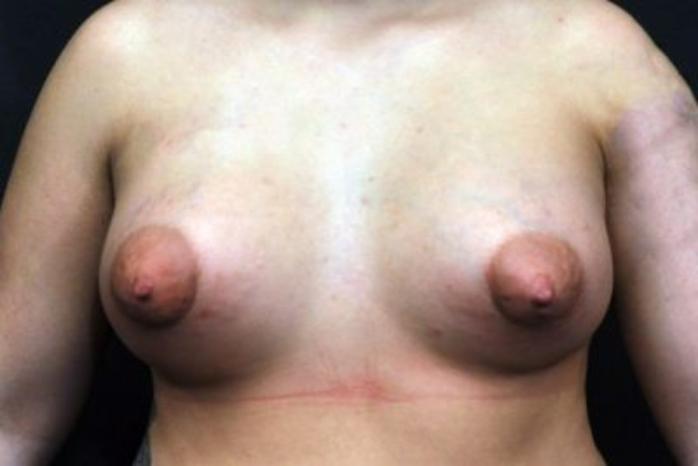 Case #1707 – Breast Augmentation