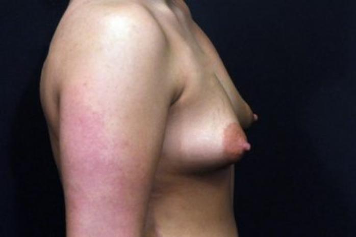 Case #1707 – Breast Augmentation