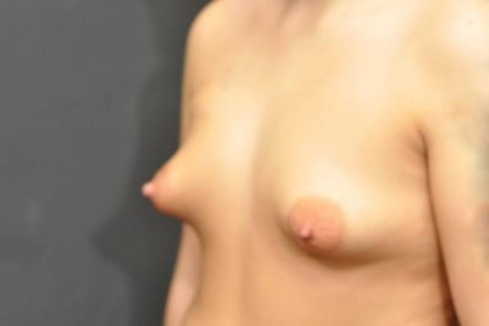 Case #1707 – Breast Augmentation