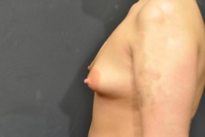 Case #1707 – Breast Augmentation