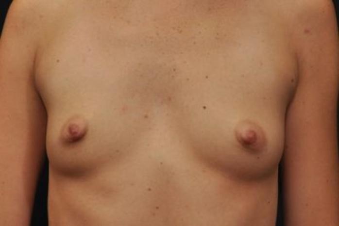 Case #1733 – Breast Augmentation