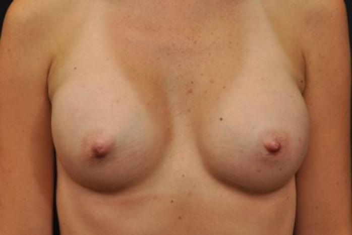 Case #1733 – Breast Augmentation
