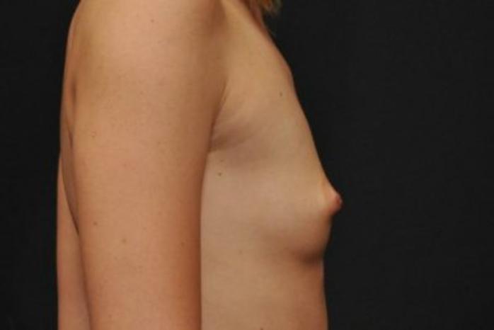 Case #1733 – Breast Augmentation