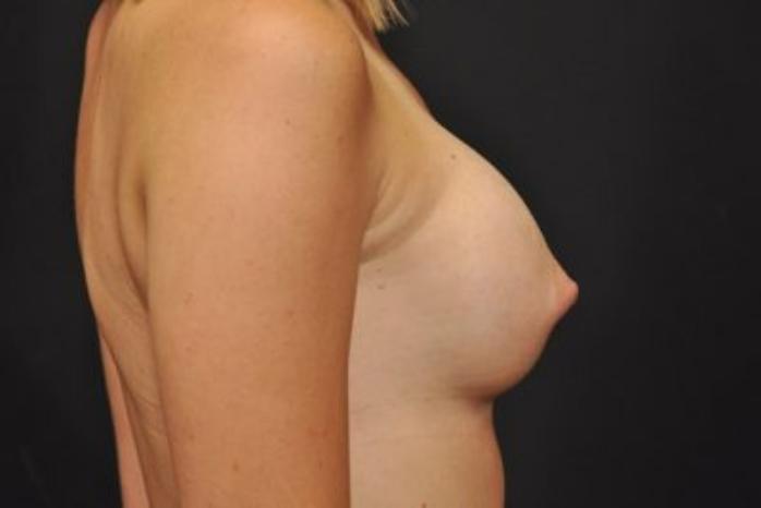 Case #1733 – Breast Augmentation