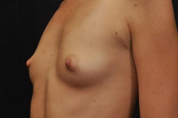 Case #1733 – Breast Augmentation
