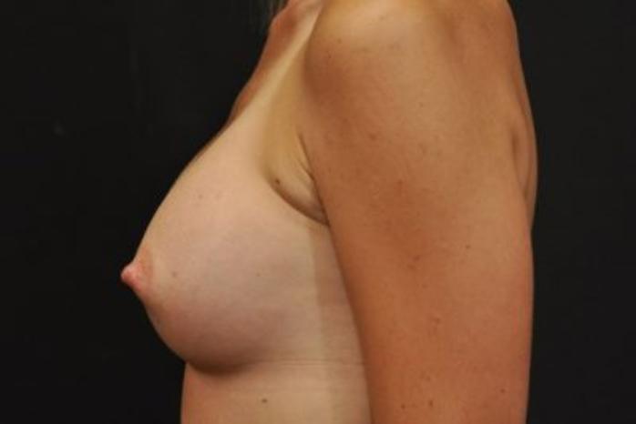 Case #1733 – Breast Augmentation
