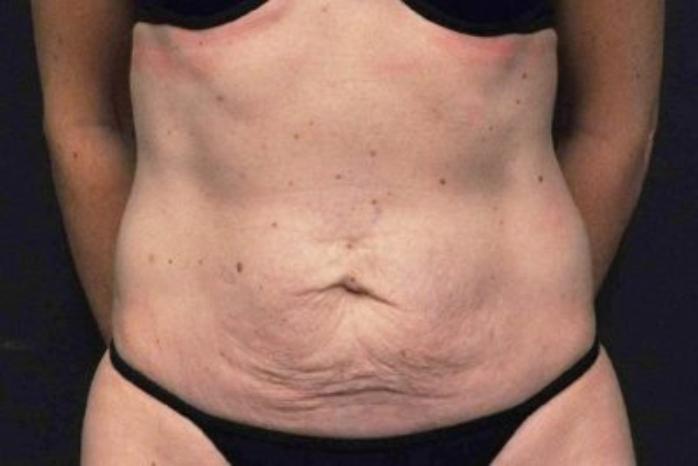 Case #200 – Tummy Tuck