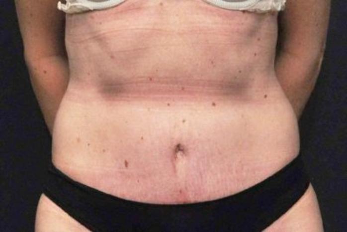 Case #200 – Tummy Tuck