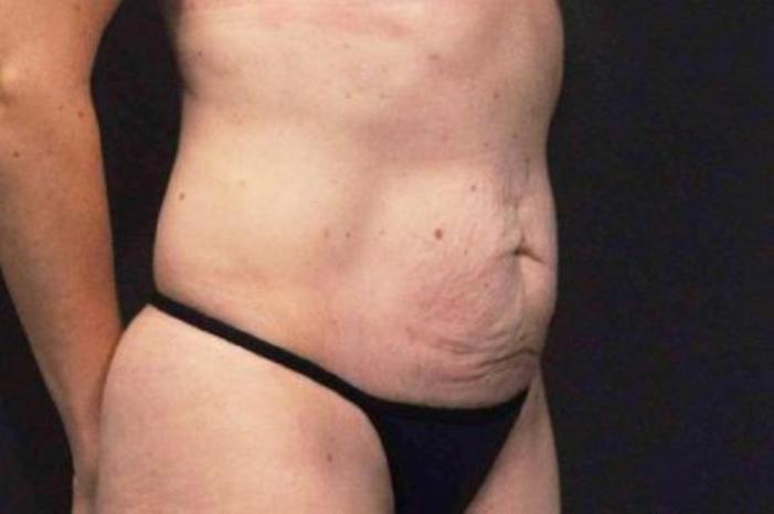 Case #200 – Tummy Tuck