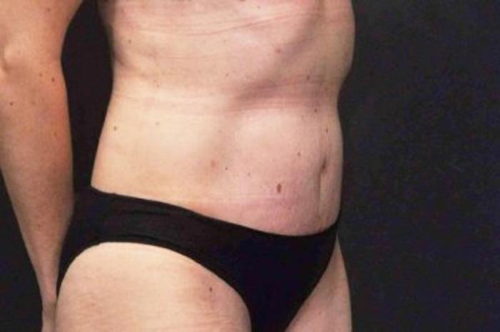 Case #200 – Tummy Tuck
