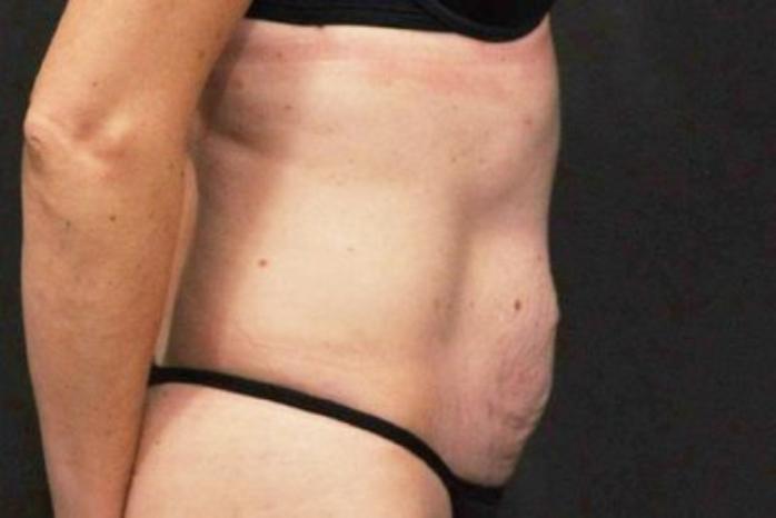 Case #200 – Tummy Tuck