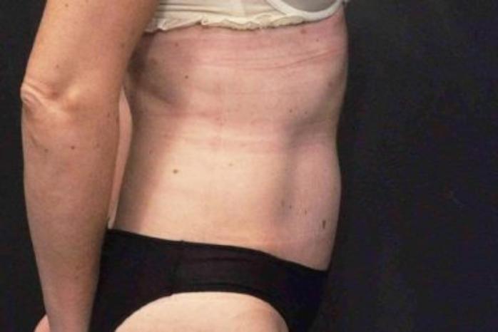 Case #200 – Tummy Tuck