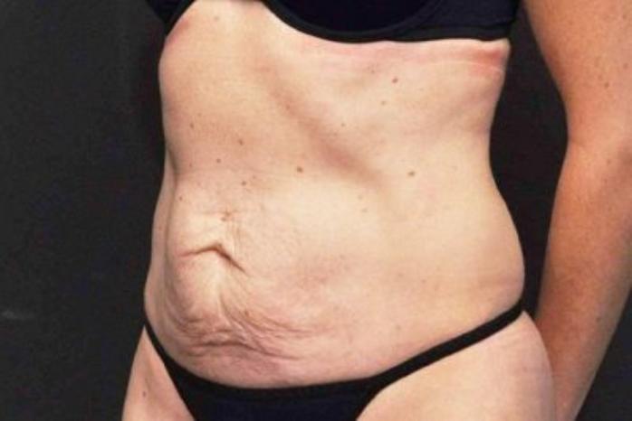 Case #200 – Tummy Tuck