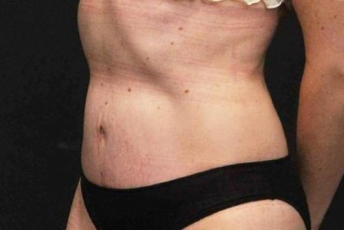 Case #200 – Tummy Tuck