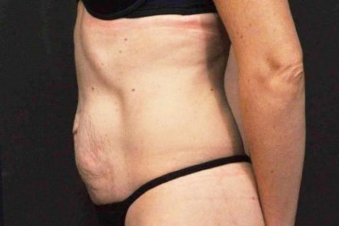 Case #200 – Tummy Tuck