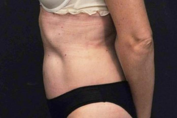 Case #200 – Tummy Tuck