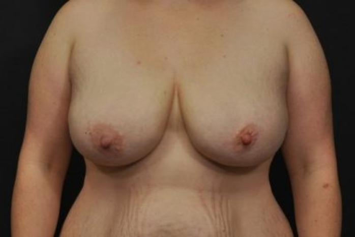 Case #2015 – Breast Lift