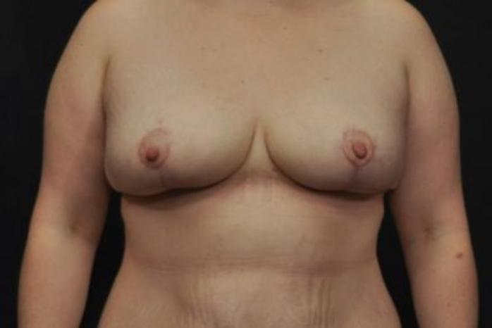 Case #2015 – Breast Lift