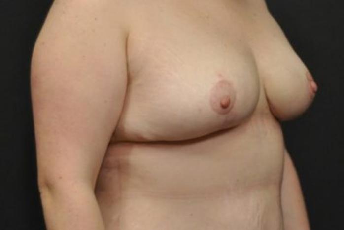 Case #2015 – Breast Lift