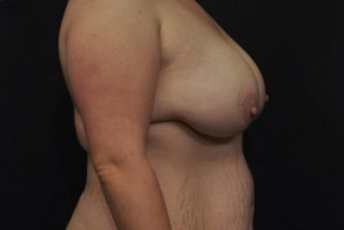 Case #2015 – Breast Lift