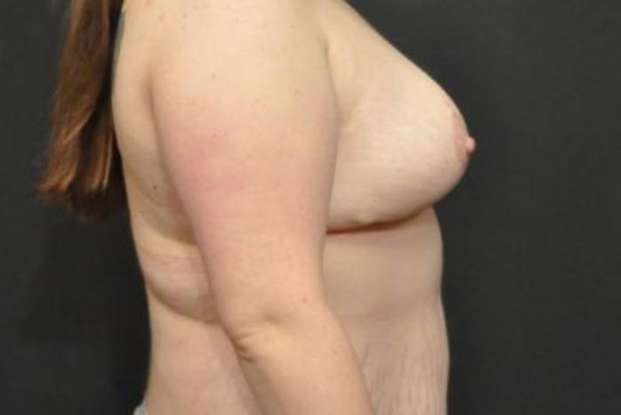Case #2015 – Breast Lift