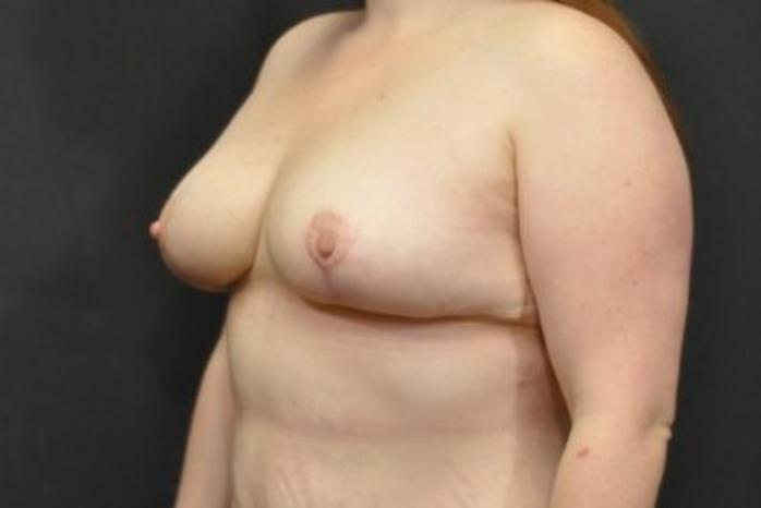 Case #2015 – Breast Lift