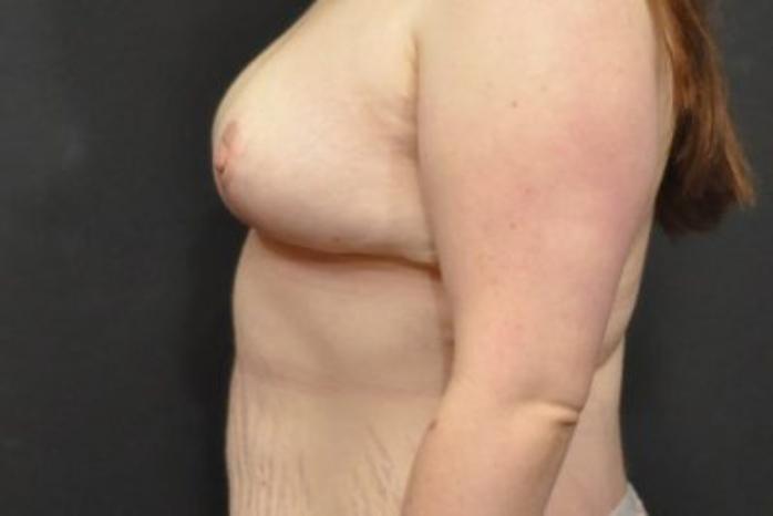 Case #2015 – Breast Lift