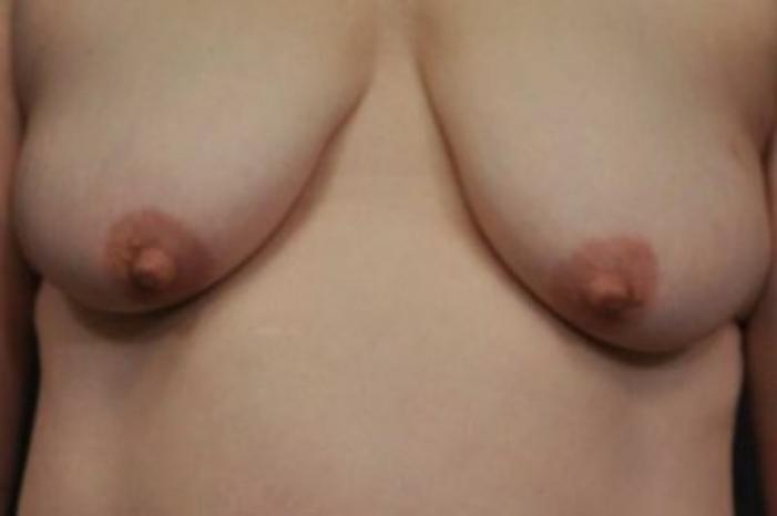 Case #2027 – Breast Lift