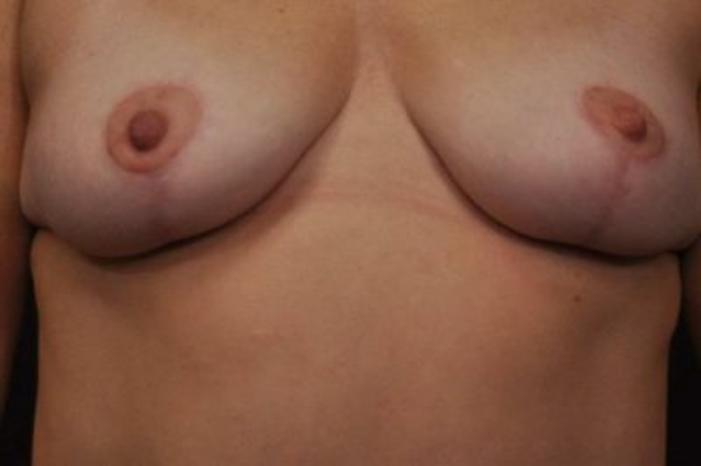 Case #2027 – Breast Lift