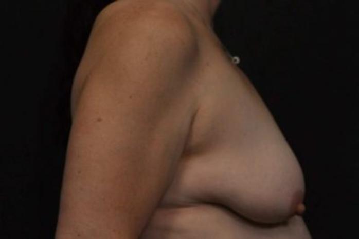 Case #2027 – Breast Lift