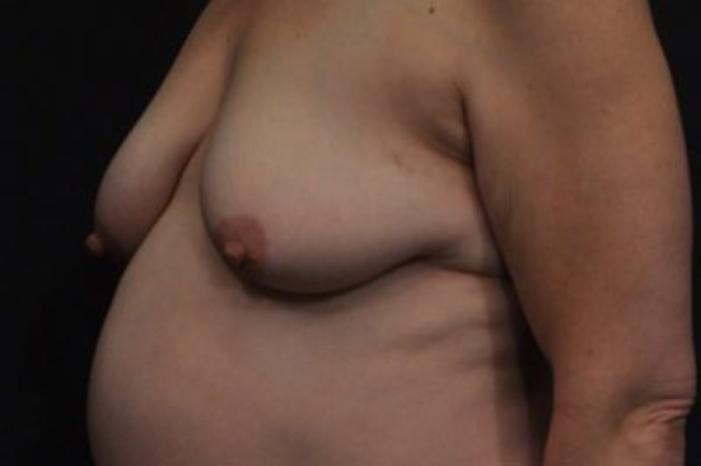 Case #2027 – Breast Lift