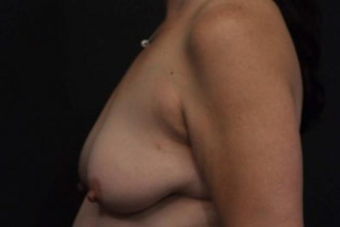 Case #2027 – Breast Lift