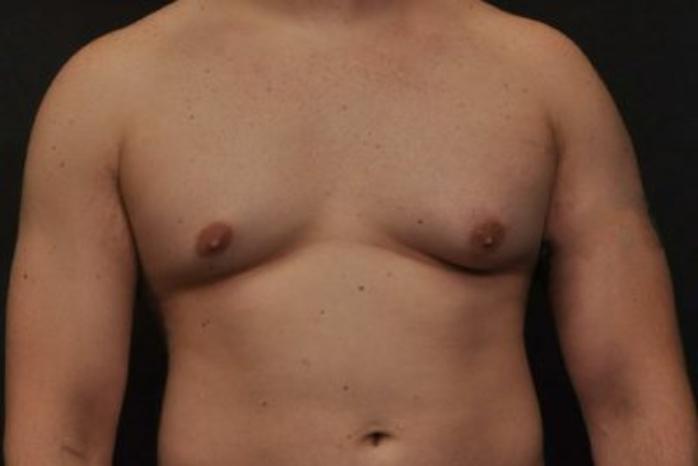 Case #2063 – Gynecomastia