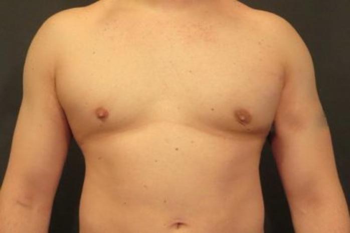 Case #2063 – Gynecomastia