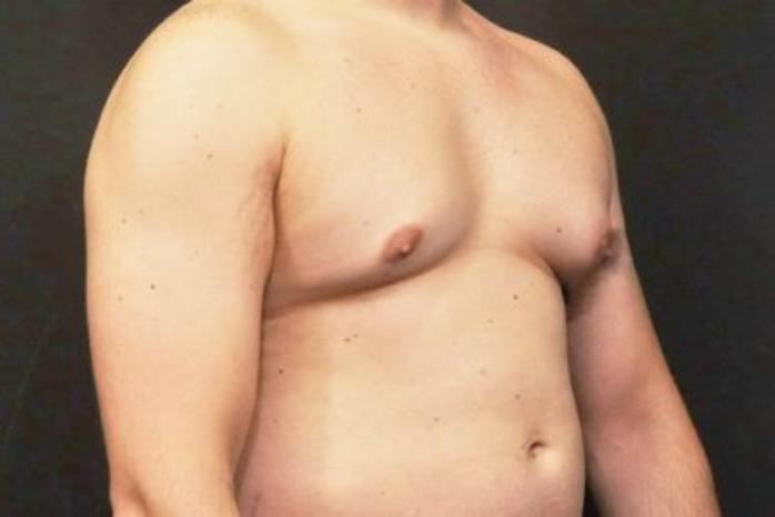 Case #2063 – Gynecomastia