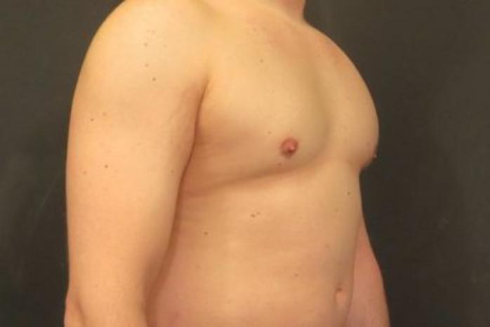 Case #2063 – Gynecomastia