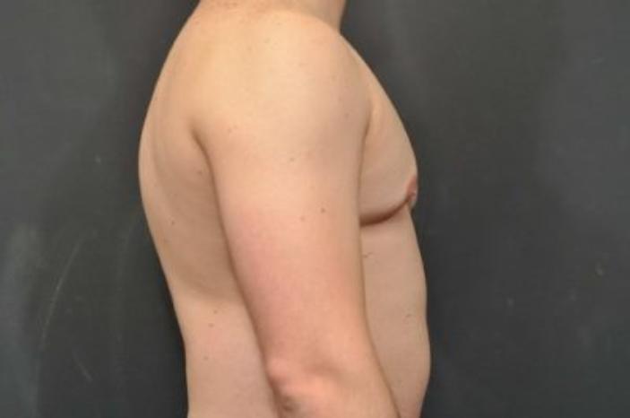 Case #2063 – Gynecomastia