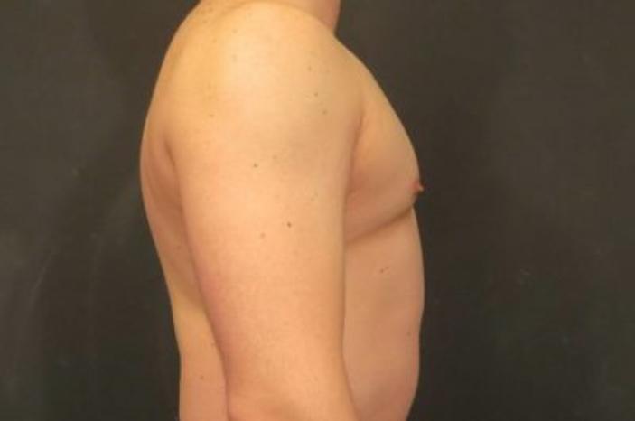 Case #2063 – Gynecomastia