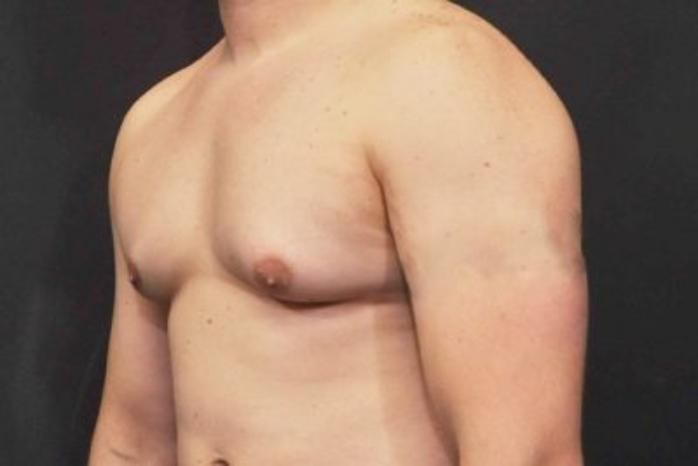 Case #2063 – Gynecomastia