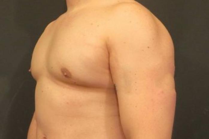 Case #2063 – Gynecomastia