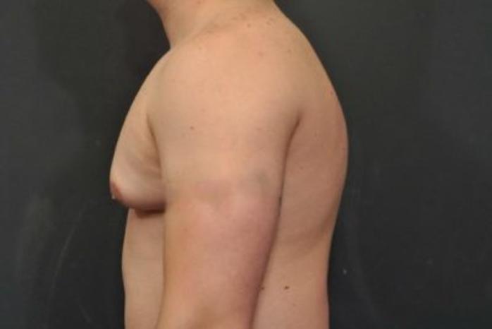 Case #2063 – Gynecomastia