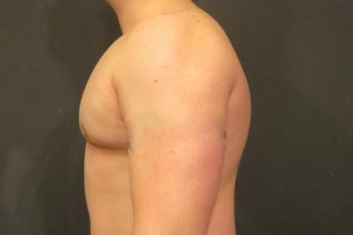 Case #2063 – Gynecomastia