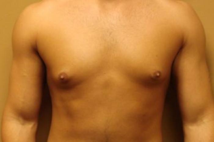 Case #2075 – Gynecomastia