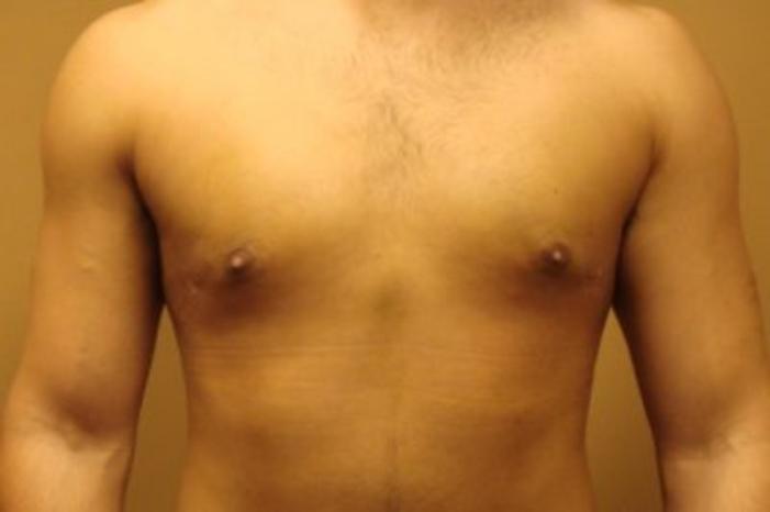 Case #2075 – Gynecomastia