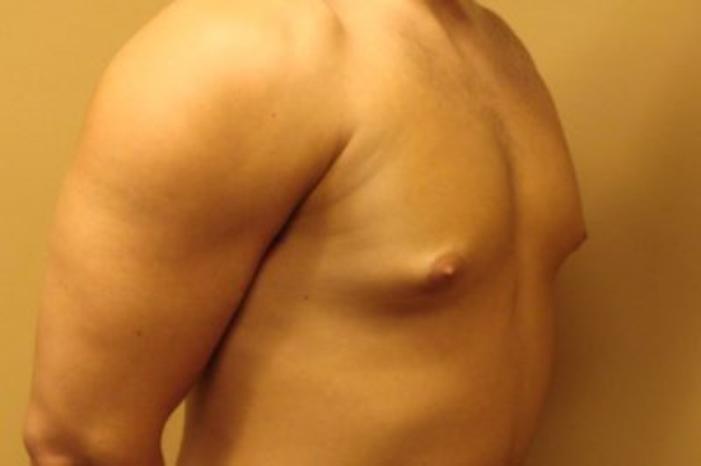 Case #2075 – Gynecomastia